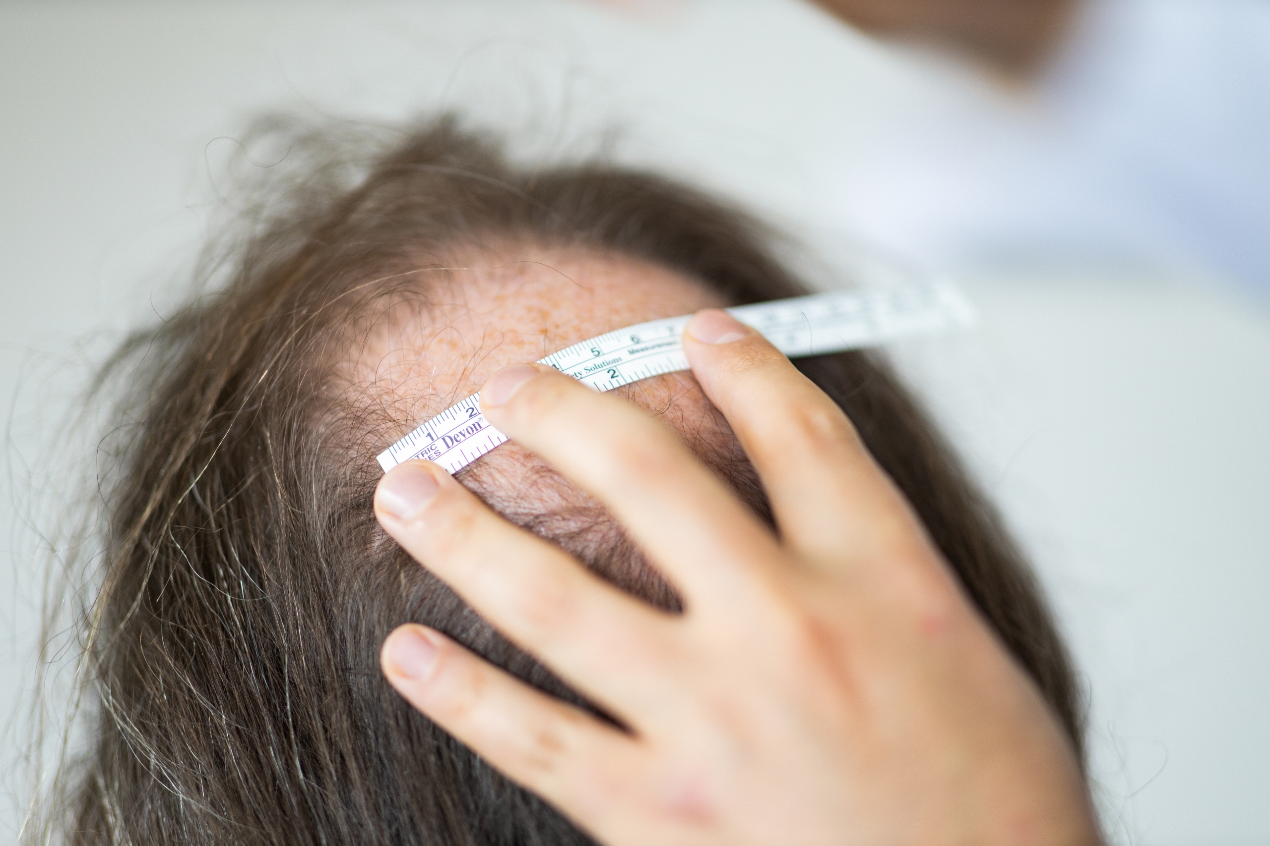 istanbul hair transplant